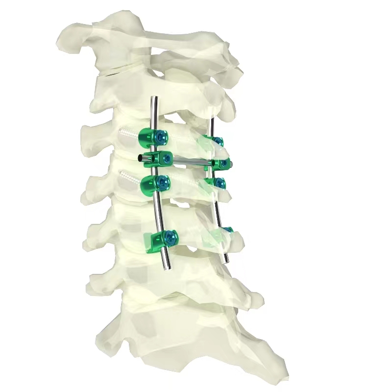 頸椎后路內(nèi)固定系統(tǒng)